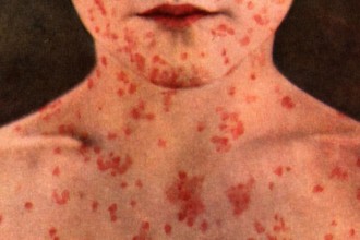 measles